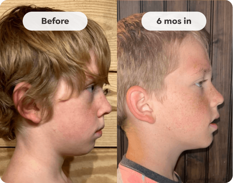 Kids Mouth Guard for Teeth Grinding
