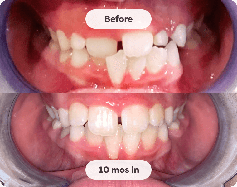 Kids Mouth Guard for Teeth Grinding
