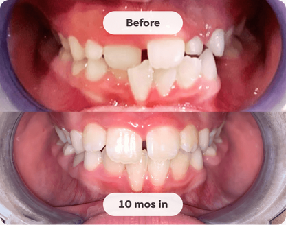 Kids Mouth Guard for Teeth Grinding